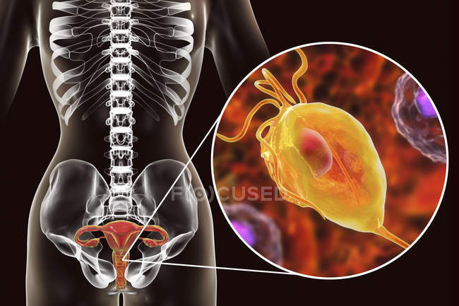 Ilustración del sistema reproductor femenino y parásito Trichomonas vaginalis causante de tricomoniasis
. - foto de stock