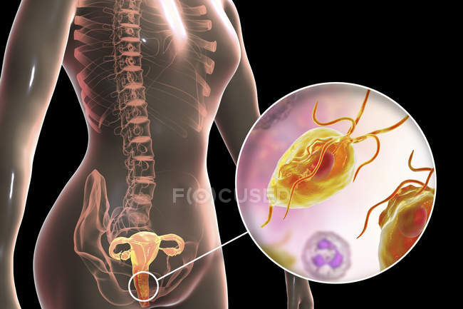 Зображення жіночої репродуктивної системи та паразитарні трихомоніаз vaginalis викликаючи трихомоніазу. — стокове фото