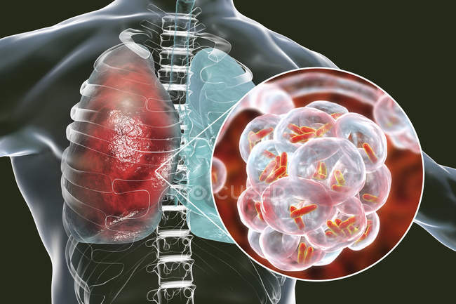 Illustration von stäbchenförmigen Bakterien in Lungenbläschen, die Infektionen der unteren Atemwege verursachen. — Stockfoto