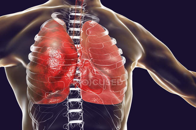 Lungenentzündung entzündlicher Zustand der Lunge, digitale Illustration. — Stockfoto