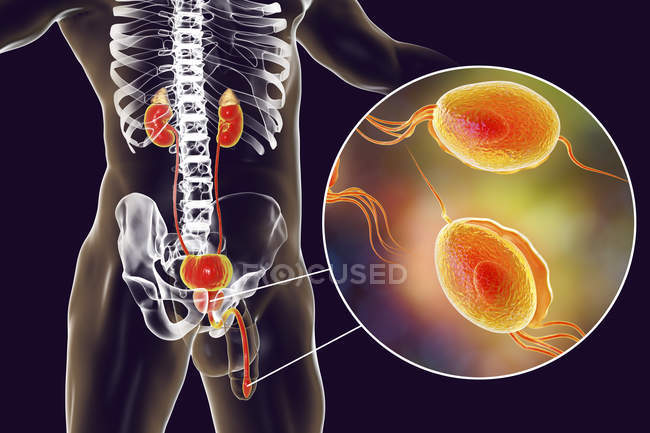 Illustration of male urinary system and parasitic Trichomonas vaginalis causing trichomoniasis. — Stock Photo