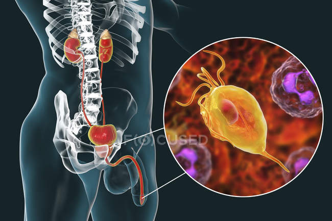 Illustration du système urinaire masculin et du parasite Trichomonas vaginalis causant la trichomonase . — Photo de stock