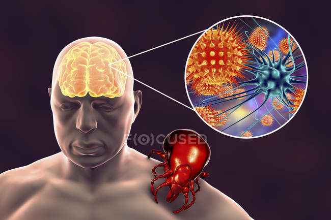 Silueta humana y encefalitis transmitida por garrapatas, ilustración digital . - foto de stock