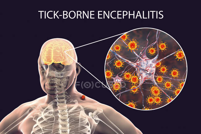 Menschliche Silhouette und von Zecken übertragene Enzephalitis, digitale Illustration. — Stockfoto