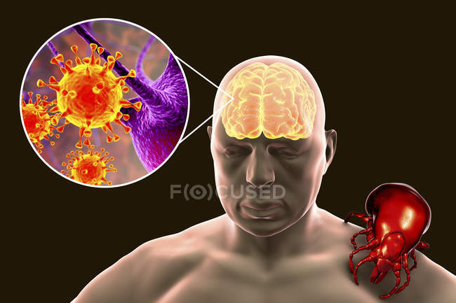 Human silhouette and tick-borne encephalitis, digital illustration. — Stock Photo