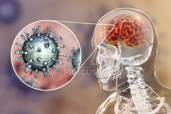 Konzeptionelle digitale Illustration der Enzephalitis durch Varizella-Zoster-Virus. — Stockfoto