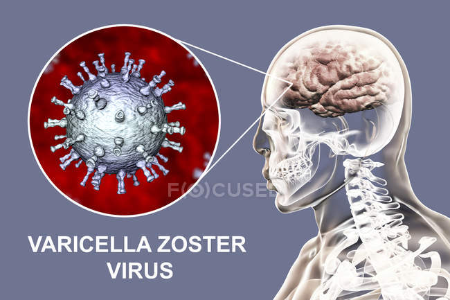 Концептуальная цифровая иллюстрация энцефалита, вызванного вирусом ветряной оспы
. — стоковое фото