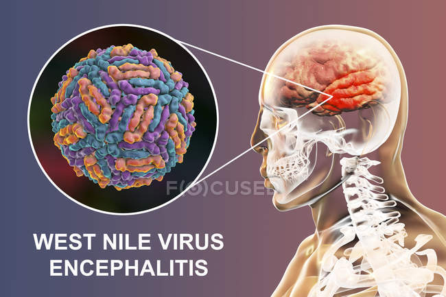 Conceptual digital illustration of encephalitis caused by West Nile virus. — Stock Photo
