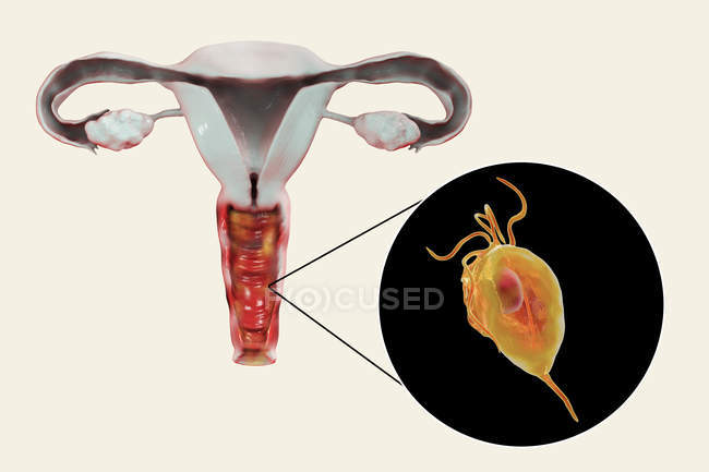 Цифрові зображення жіночої репродуктивної системи та паразитарні мікроорганізму трихомоніаз vaginalis викликаючи трихомоніазу. — стокове фото