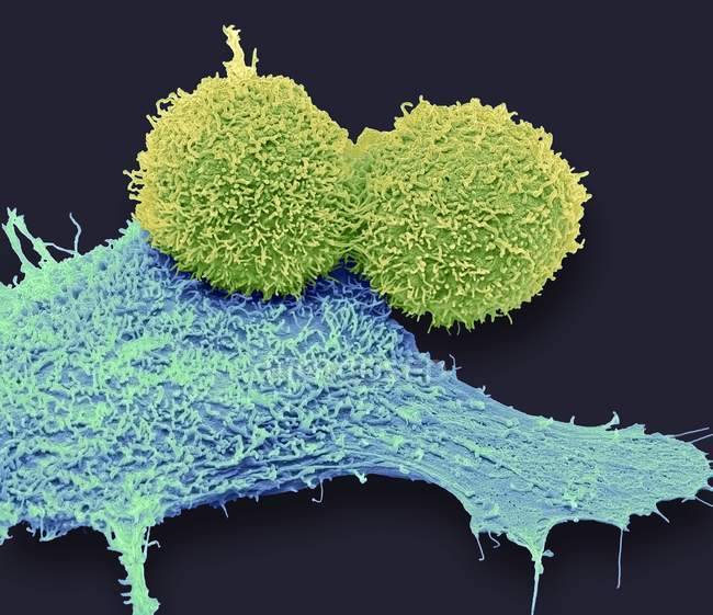 Кольорові мікрофотографія клітин раку молочної залози. — стокове фото