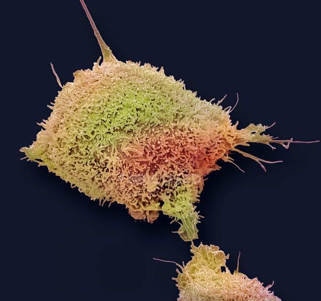 Micrógrafo electrónico de barrido coloreado de células cancerosas cultivadas del cuello uterino humano que muestra numerosas microvellosidades . - foto de stock