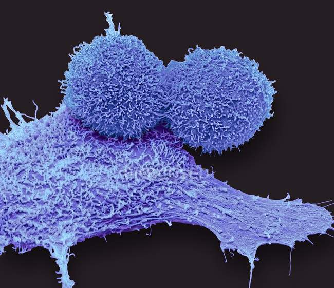 Micrógrafo electrónico de barrido coloreado de células cancerosas de mama . - foto de stock