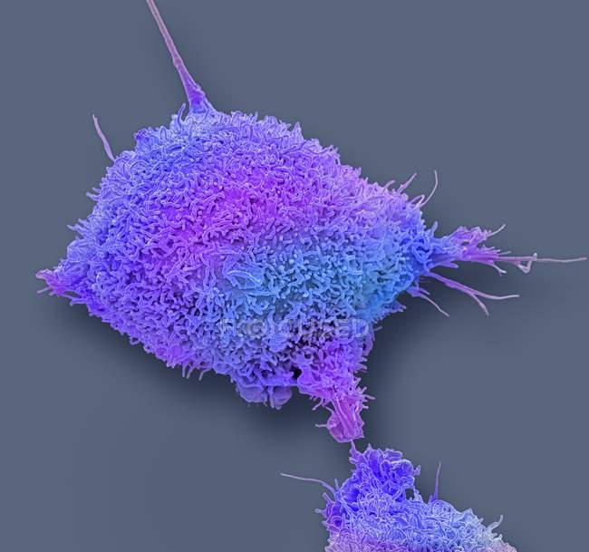 Micrógrafo electrónico de barrido coloreado de células cancerosas cultivadas del cuello uterino humano que muestra numerosas microvellosidades
. - foto de stock