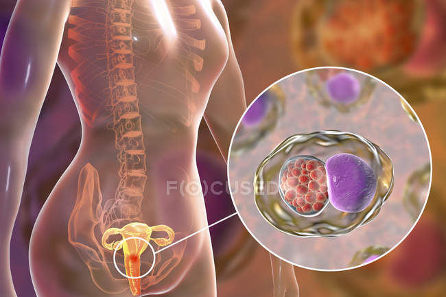 Ilustración digital del sistema reproductor femenino y de la bacteria Chlamydia trachomatis que causa la infección por clamidia . - foto de stock