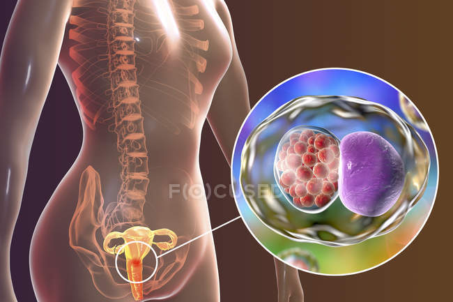Digitale Illustration des weiblichen Fortpflanzungssystems und der Chlamydia trachomatis Bakterien, die eine Chlamydialinfektion verursachen. — Stockfoto