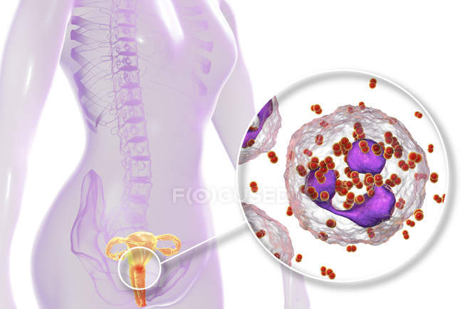 Nahaufnahme bakterieller Gonorrhoe-Infektion im weiblichen Körper, digitale Illustration. — Stockfoto