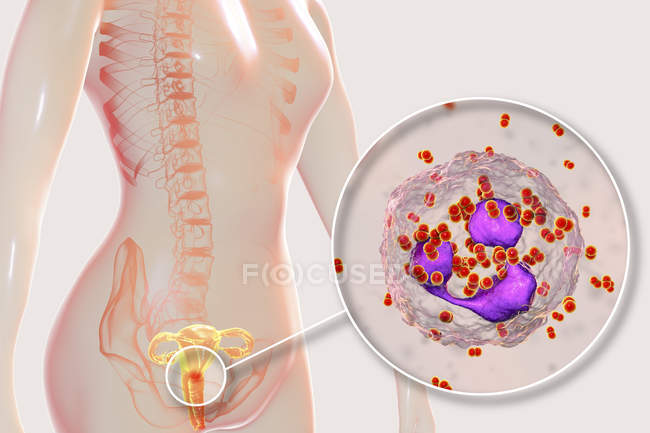 Закри бактеріальних гонореї інфекції в жіноче тіло, цифрова ілюстрація. — стокове фото