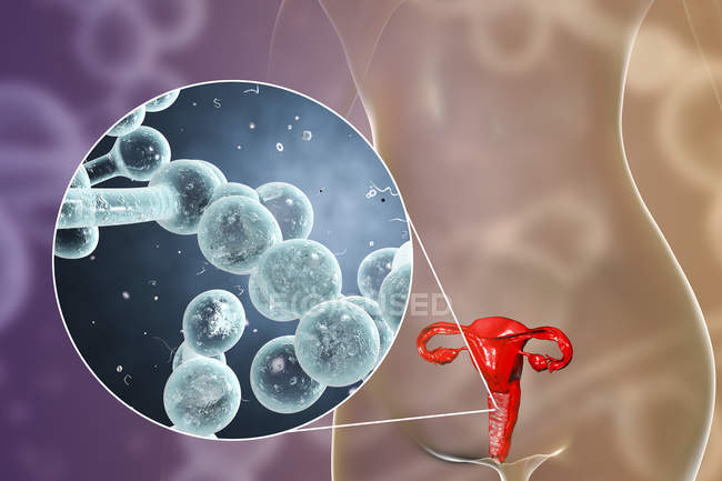 Ilustración digital que muestra vaginitis causada por hongo Candida albicans y primer plano de las células de levadura
. - foto de stock
