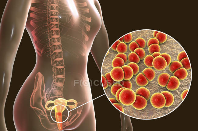 Primer plano de la infección por gonorrea bacteriana en el cuerpo femenino, ilustración digital . - foto de stock