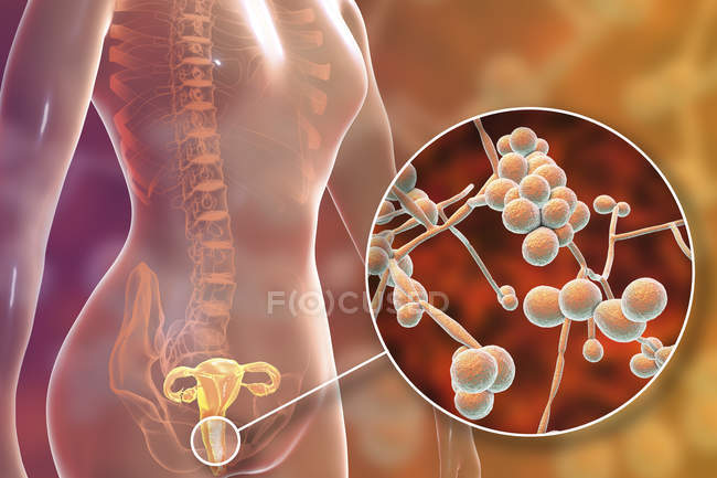 Digital illustration showing vaginitis caused by Candida albicans fungus and close-up of yeast cells. — Stock Photo