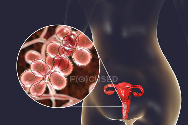Ilustración digital que muestra vaginitis causada por hongo Candida albicans y primer plano de las células de levadura
. - foto de stock