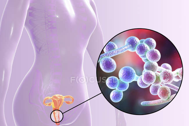 Цифровая иллюстрация, показывающая вагинит, вызванный грибком Candida albicans и крупным планом дрожжевых клеток . — стоковое фото