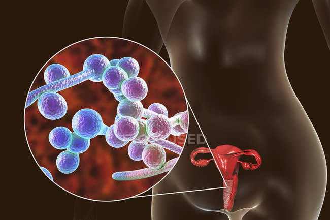 Цифровий ілюстрація вагініт, викликаних Candida albicans грибок і Закри дріжджових клітин. — стокове фото