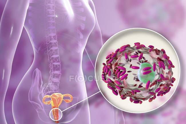 Appareil reproducteur femelle et bactéries Gardnerella vaginalis attachées aux cellules épithéliales vaginales causant une vaginose bactérienne, illustration numérique . — Photo de stock