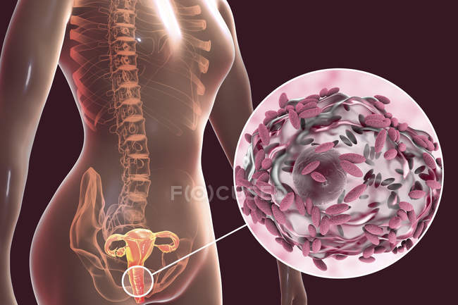 Female reproductive system and Gardnerella vaginalis bacteria attached to vaginal epithelial cells causing bacterial vaginosis, digital illustration. — Stock Photo