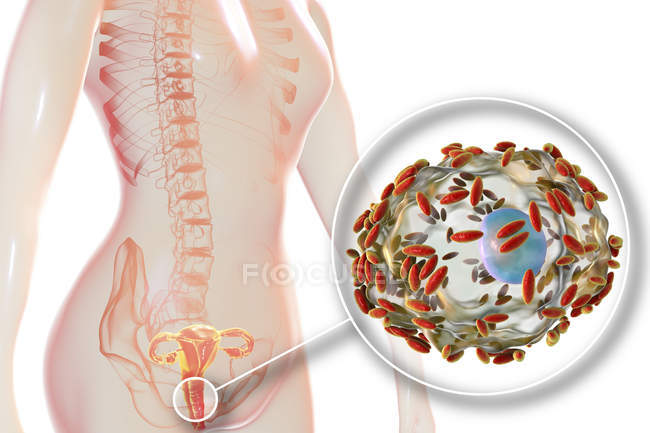 Sistema riproduttivo femminile e batteri Gardnerella vaginalis attaccati alle cellule epiteliali vaginali causando vaginosi batterica, illustrazione digitale . — Foto stock