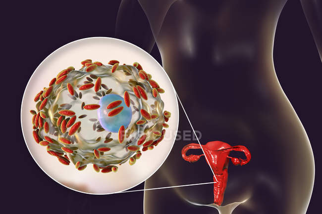 Sistema riproduttivo femminile e batteri Gardnerella vaginalis attaccati alle cellule epiteliali vaginali causando vaginosi batterica, illustrazione digitale . — Foto stock
