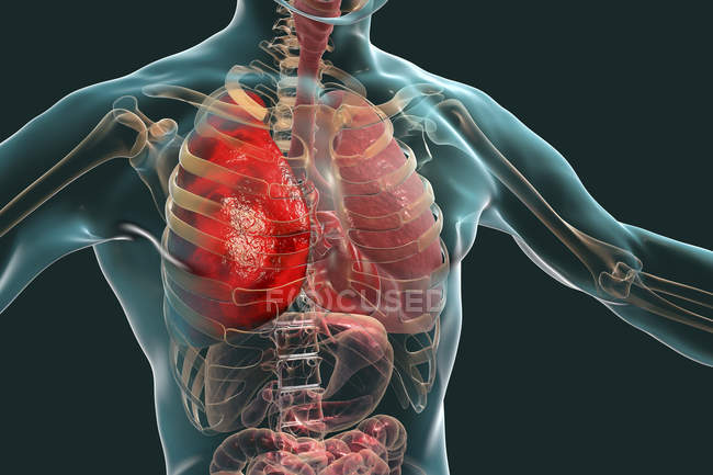 Pneumonie inflammatoire des poumons, illustration numérique
. — Photo de stock