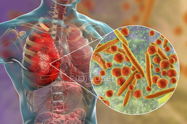 Pneumonie causée par la bactérie Mycoplasma pneumoniae, illustration numérique conceptuelle
. — Photo de stock