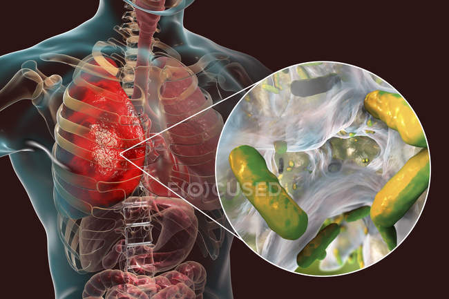 Lungenentzündung durch Bakterien pseudomonas aeruginosa, digitale Illustration. — Stockfoto