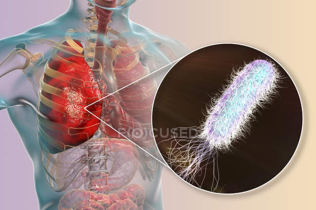 Пневмонія, викликані бактерія синьогнійна паличка, цифрова ілюстрація. — стокове фото