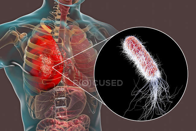 Пневмония, вызванная бактерией Pseudomonas aeruginosa, цифровая иллюстрация
. — стоковое фото