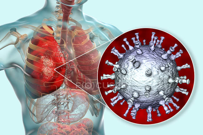 Пневмония, вызванная вирусом ветряной оспы, цифровая иллюстрация
. — стоковое фото