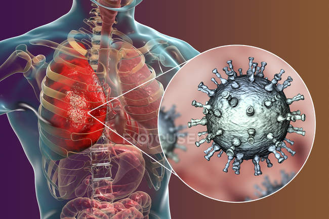 Пневмонія, викликана вірусом вітряної віспи оперізувального, цифрова ілюстрація. — Stock Photo