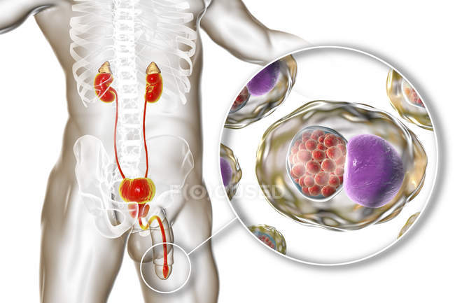 Ilustração digital da silhueta masculina com esfregaço uretral mostrando infecção Chlamydial com bactérias Chlamydia trachomatis . — Fotografia de Stock