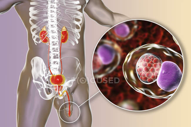 Цифровий ілюстрація чоловічий силует з уретри мазка, показуючи хламідійної інфекції з бактеріями хламідіоз рання. — стокове фото