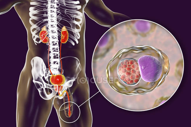Illustrazione digitale della silhouette maschile con striscio uretrale che mostra infezione clamidia con batteri Chlamydia trachomatis . — Foto stock