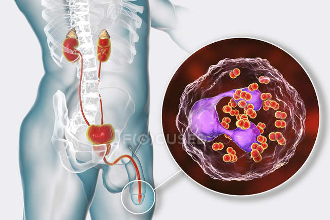 Nahaufnahme bakterieller Gonorrhoe-Infektion im männlichen Körper, digitale Illustration. — Stockfoto