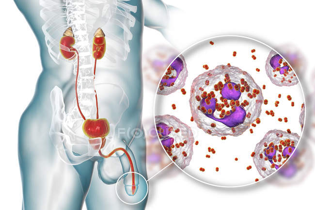 Primer plano de la infección por gonorrea bacteriana en el cuerpo masculino, ilustración digital
. - foto de stock