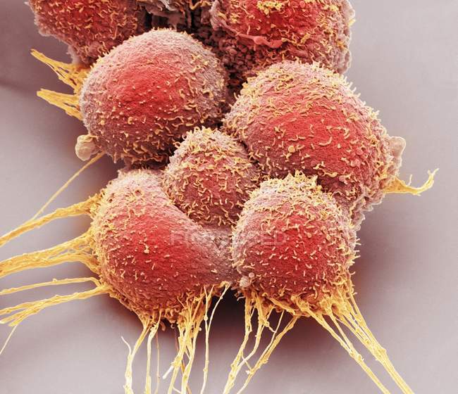 Рак передміхурової залози клітини, кольорові сканування електронна мікрофотографія. — стокове фото