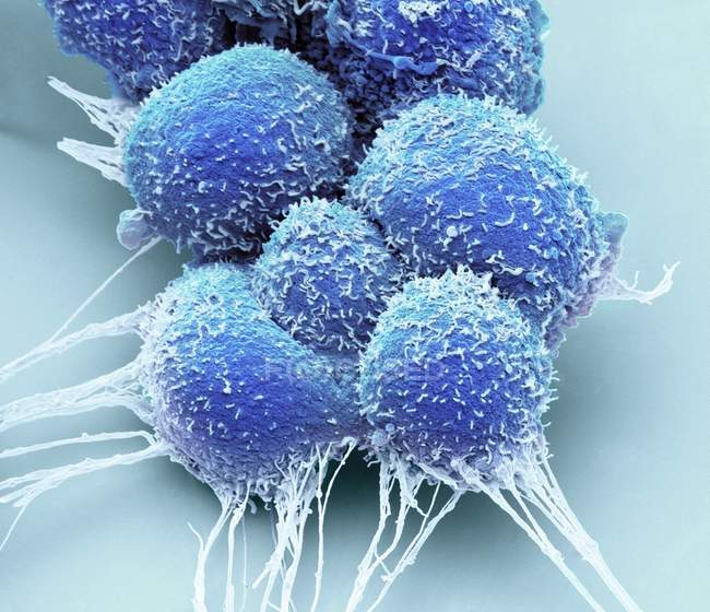 Células cancerosas de próstata, micrografía electrónica de barrido coloreado
. - foto de stock