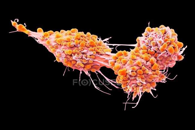 Ovarian cancer cells, coloured scanning electron micrograph. — Stock Photo