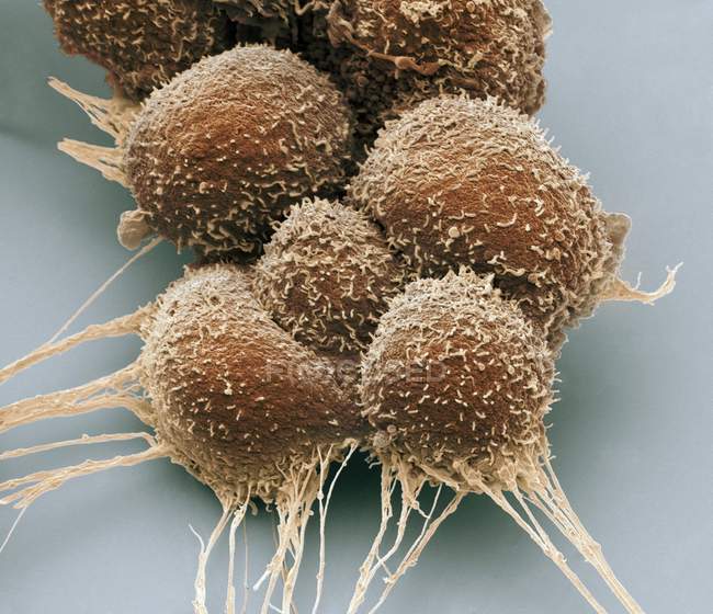 Células cancerosas de próstata, micrografía electrónica de barrido coloreado . - foto de stock
