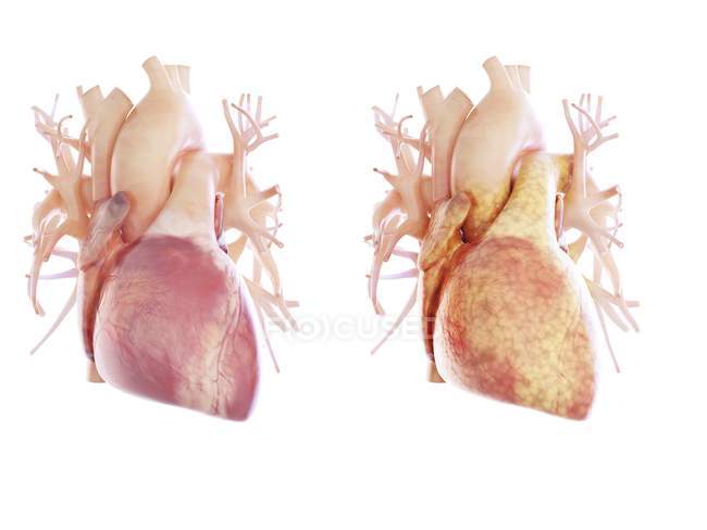 Illustration of healthy and fatty heart on white background. — Stock Photo