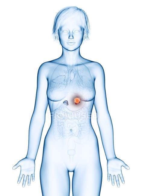 Ilustración médica del cáncer de glándula suprarrenal en la silueta femenina
. - foto de stock