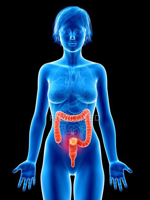 Medizinische Illustration von Dickdarmkrebs in weiblicher Silhouette. — Stockfoto